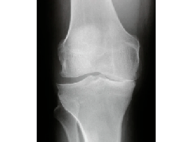 Diagnoza artroze kolenskega sklepa