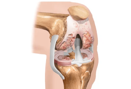 arthroza ali artritis razlik