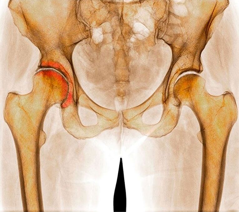 Arthroza kolčnega sklepa