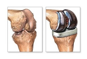 nadomestitev kolena za artrozo