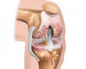 začetna stopnja artroze kolena