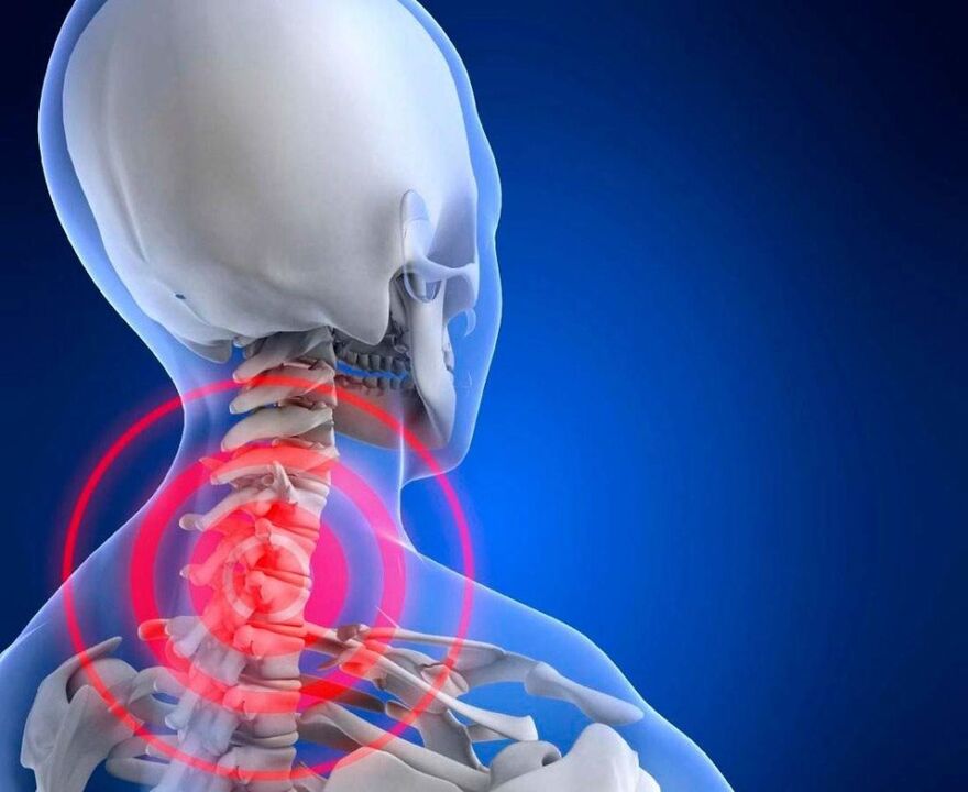 Bolečine v vratu z osteohondrozo materničnega vratu