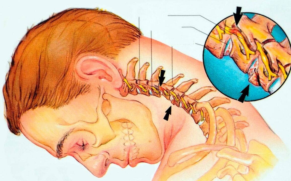 Kaj je osteohondroza materničnega vratu