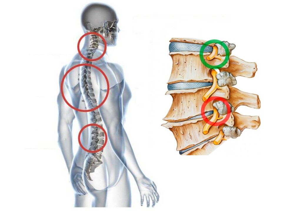 Kako izgleda osteohondroza materničnega vratu