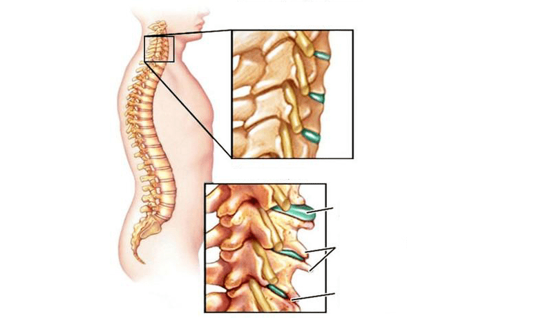 Sindromi osteohondroze