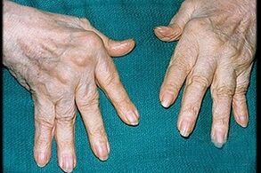 simptomi artritisa v prstih