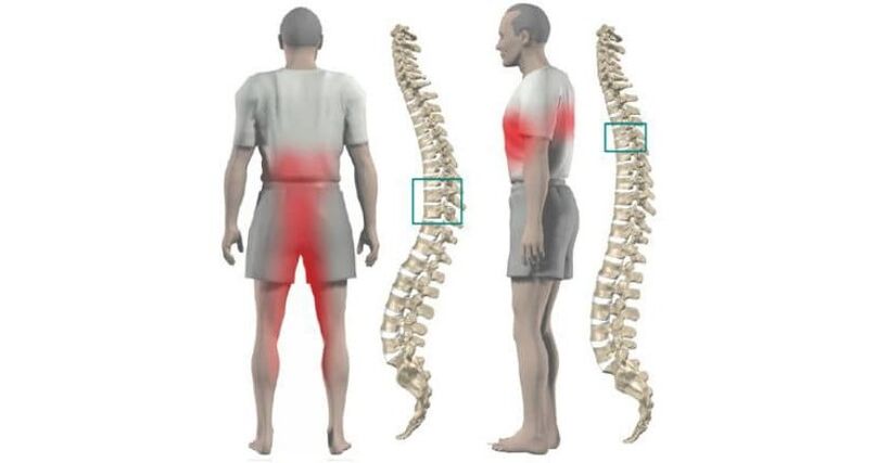 bolečine v telesu in hrbtenici z osteohondrozo
