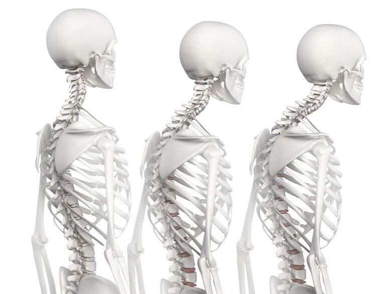 Stopnje razvoja torakalne osteohondroze na primeru skeletnega modela