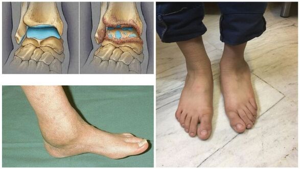 Oteklina in deformacija gležnjev zaradi artroze