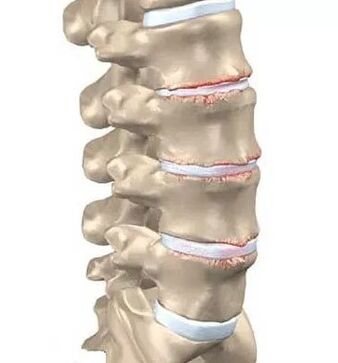 Osteohondroza